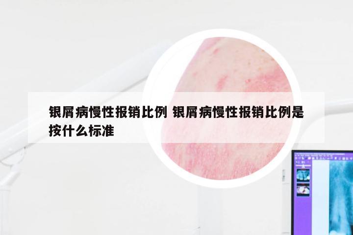 银屑病慢性报销比例 银屑病慢性报销比例是按什么标准