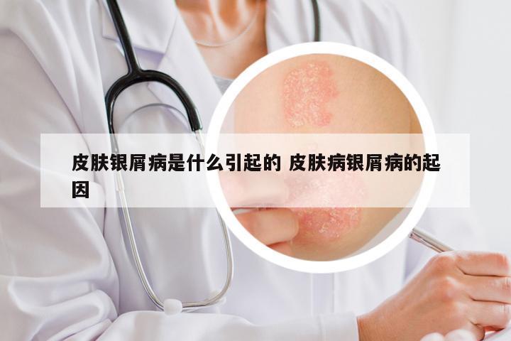 皮肤银屑病是什么引起的 皮肤病银屑病的起因