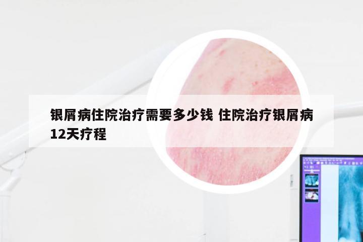 银屑病住院治疗需要多少钱 住院治疗银屑病12天疗程