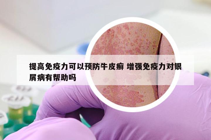 提高免疫力可以预防牛皮癣 增强免疫力对银屑病有帮助吗