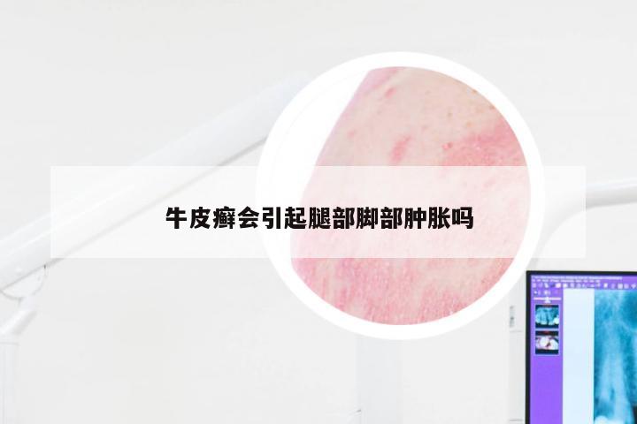 牛皮癣会引起腿部脚部肿胀吗