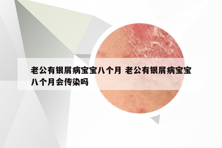 老公有银屑病宝宝八个月 老公有银屑病宝宝八个月会传染吗