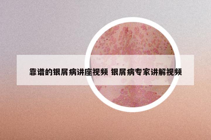 靠谱的银屑病讲座视频 银屑病专家讲解视频