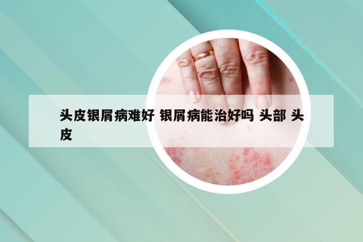 头皮银屑病难好 银屑病能治好吗 头部 头皮