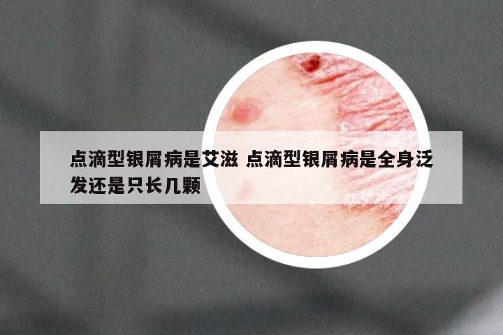 点滴型银屑病是艾滋 点滴型银屑病是全身泛发还是只长几颗
