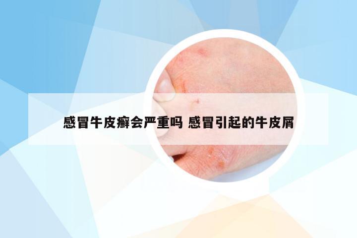 感冒牛皮癣会严重吗 感冒引起的牛皮屑