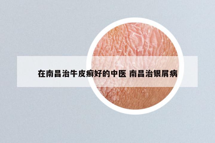 在南昌治牛皮癣好的中医 南昌治银屑病