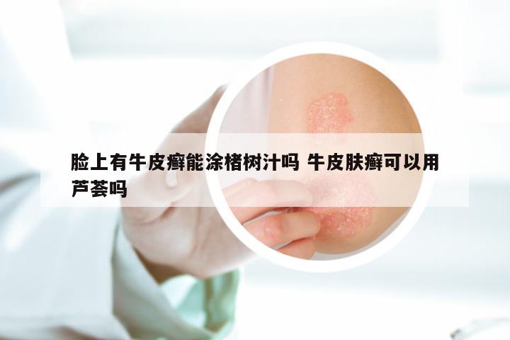 脸上有牛皮癣能涂楮树汁吗 牛皮肤癣可以用芦荟吗