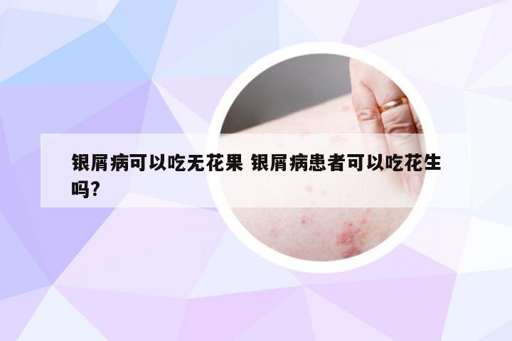 银屑病可以吃无花果 银屑病患者可以吃花生吗?
