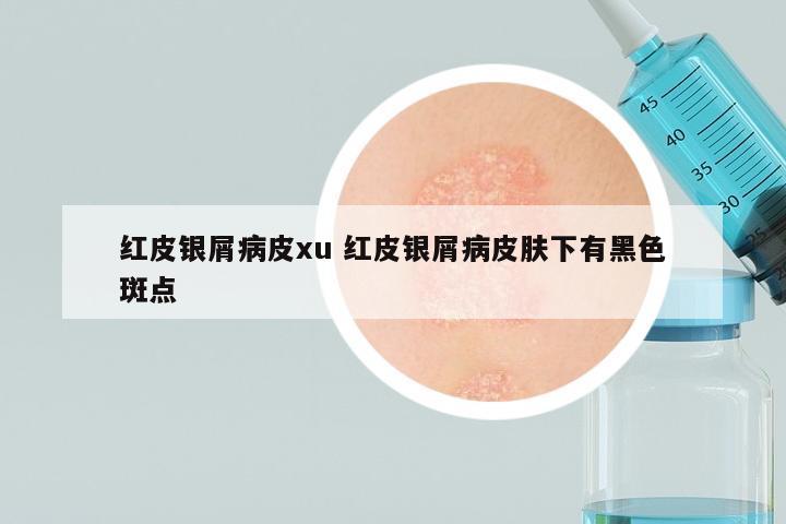红皮银屑病皮xu 红皮银屑病皮肤下有黑色斑点