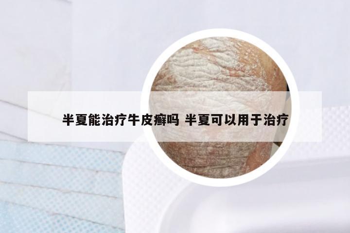 半夏能治疗牛皮癣吗 半夏可以用于治疗