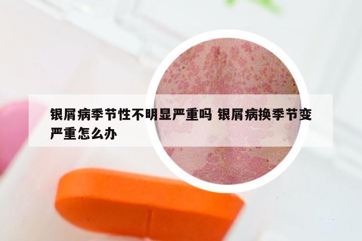 银屑病季节性不明显严重吗 银屑病换季节变严重怎么办