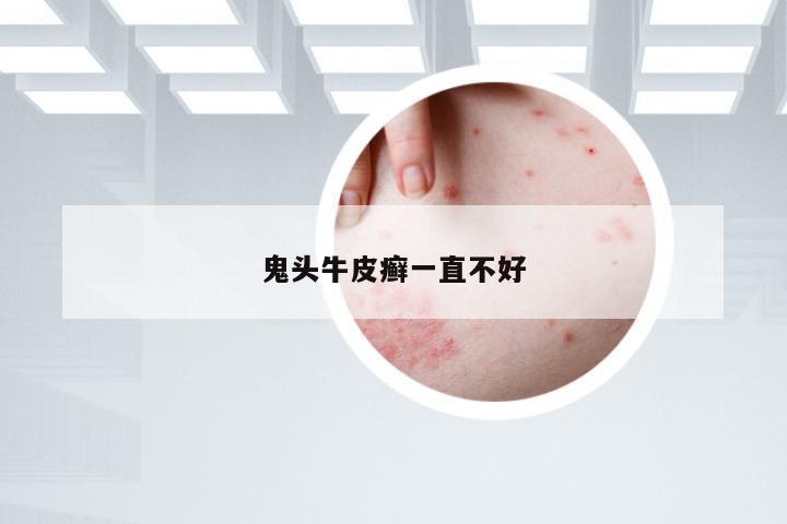 鬼头牛皮癣一直不好