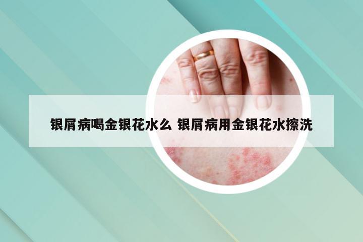 银屑病喝金银花水么 银屑病用金银花水擦洗