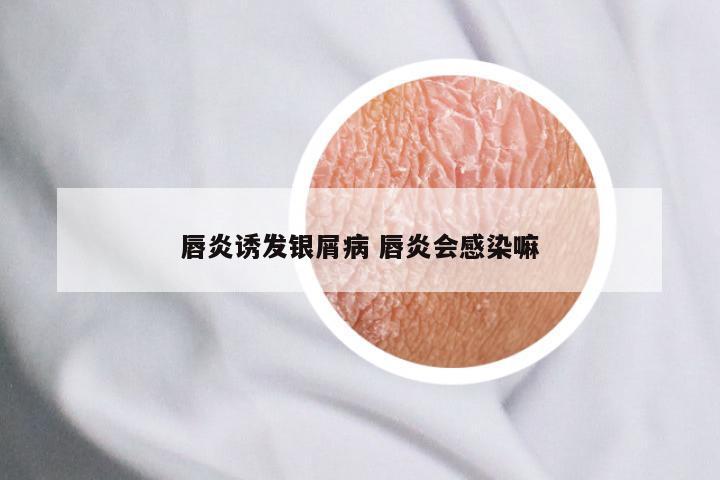 唇炎诱发银屑病 唇炎会感染嘛