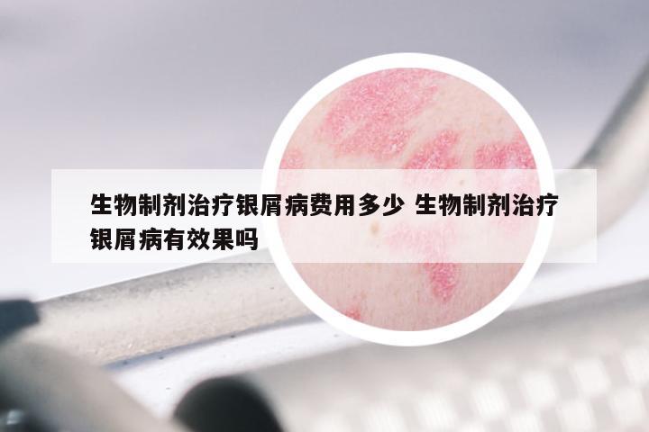 生物制剂治疗银屑病费用多少 生物制剂治疗银屑病有效果吗