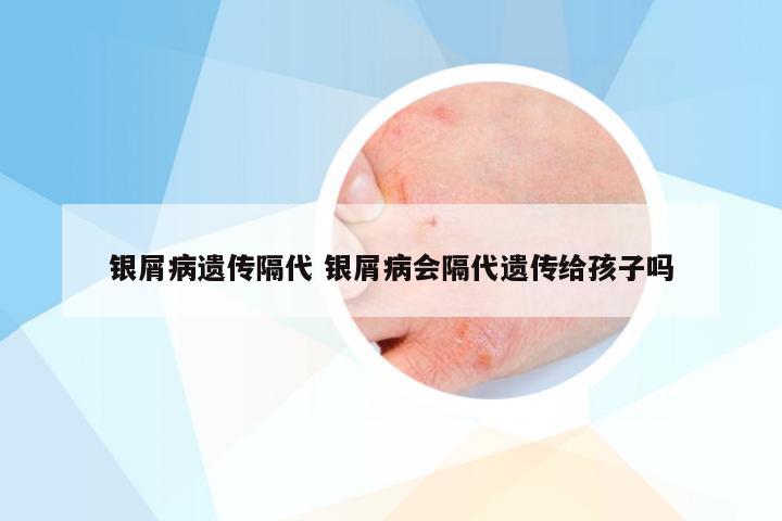 银屑病遗传隔代 银屑病会隔代遗传给孩子吗