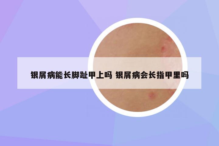 银屑病能长脚趾甲上吗 银屑病会长指甲里吗