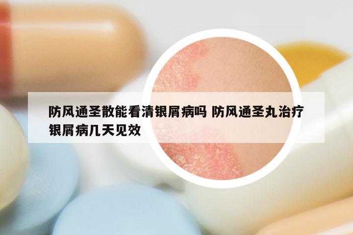 防风通圣散能看清银屑病吗 防风通圣丸治疗银屑病几天见效