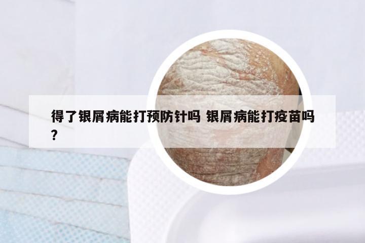 得了银屑病能打预防针吗 银屑病能打疫苗吗?