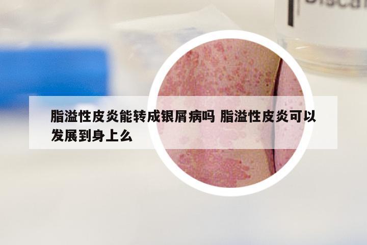 脂溢性皮炎能转成银屑病吗 脂溢性皮炎可以发展到身上么