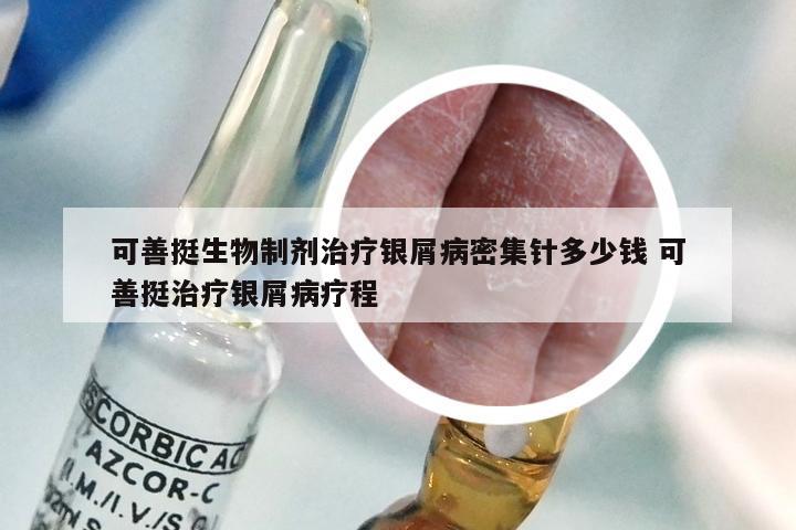 可善挺生物制剂治疗银屑病密集针多少钱 可善挺治疗银屑病疗程