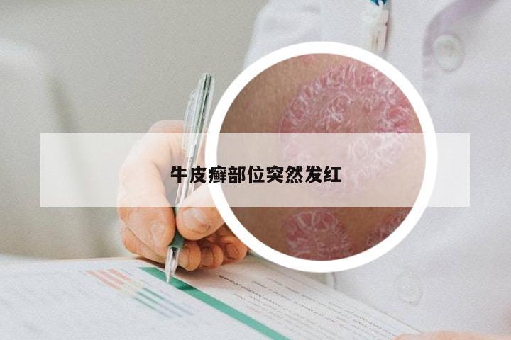 牛皮癣部位突然发红