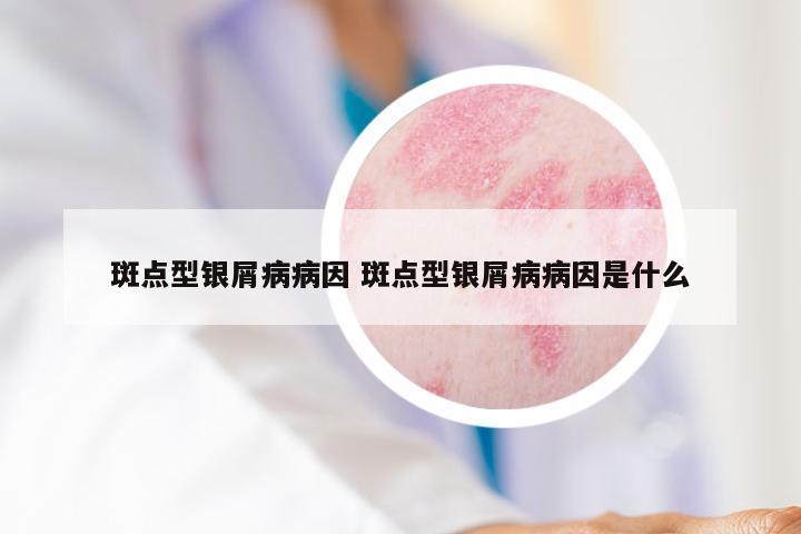 斑点型银屑病病因 斑点型银屑病病因是什么