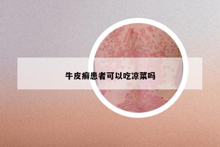 牛皮癣患者可以吃凉菜吗