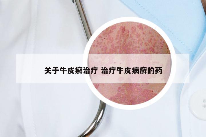 关于牛皮癣治疗 治疗牛皮病癣的药