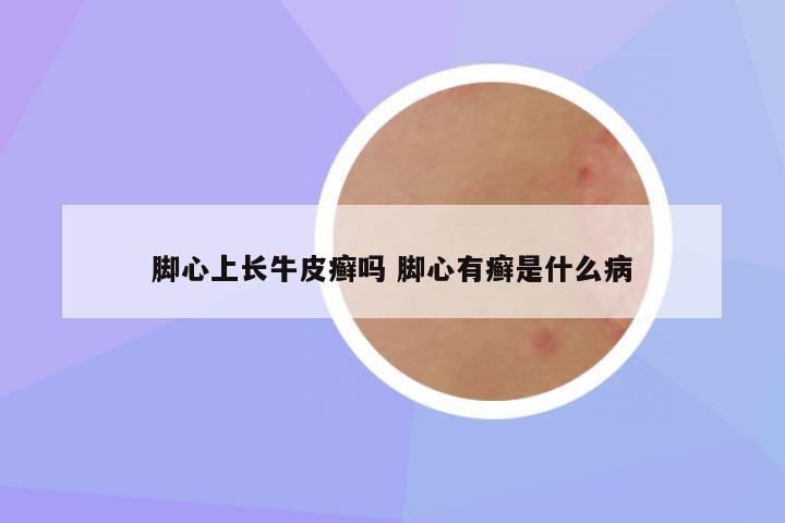 脚心上长牛皮癣吗 脚心有癣是什么病