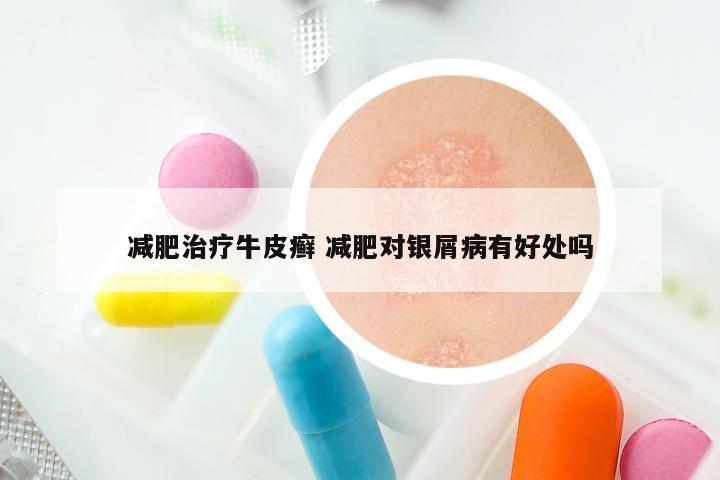 减肥治疗牛皮癣 减肥对银屑病有好处吗
