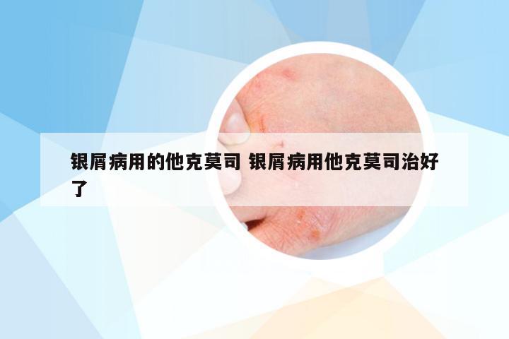 银屑病用的他克莫司 银屑病用他克莫司治好了