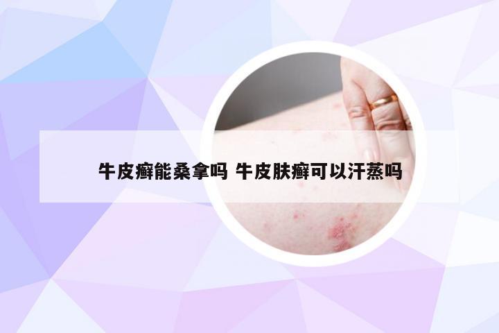 牛皮癣能桑拿吗 牛皮肤癣可以汗蒸吗