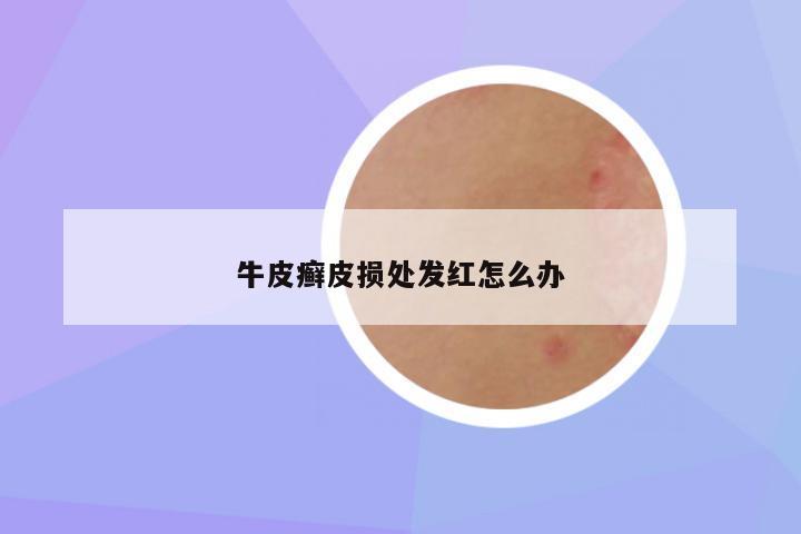牛皮癣皮损处发红怎么办