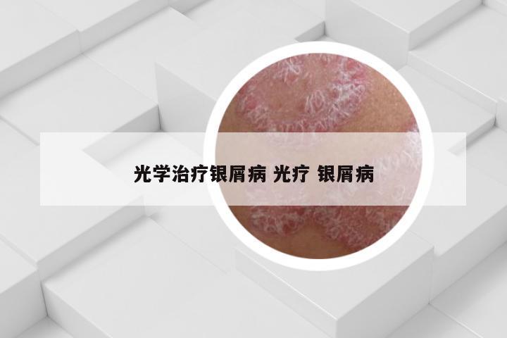 光学治疗银屑病 光疗 银屑病