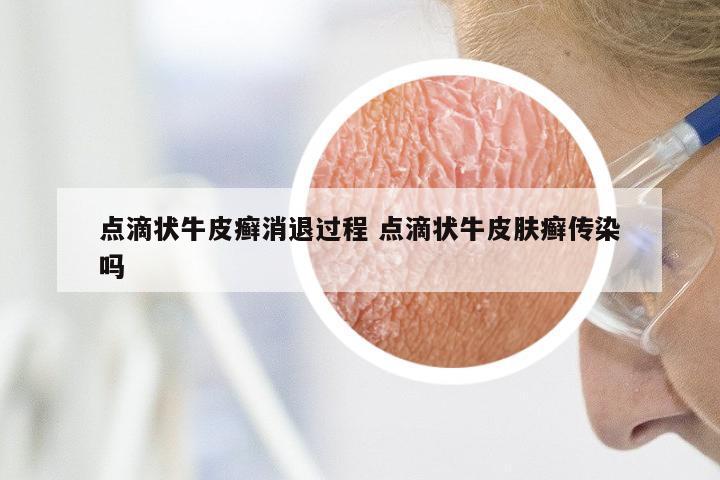 点滴状牛皮癣消退过程 点滴状牛皮肤癣传染吗