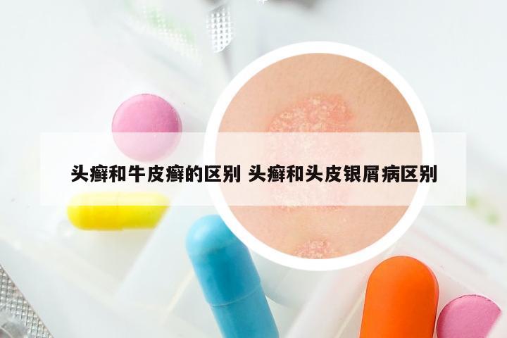 头癣和牛皮癣的区别 头癣和头皮银屑病区别
