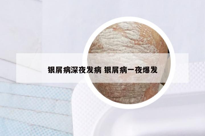 银屑病深夜发病 银屑病一夜爆发