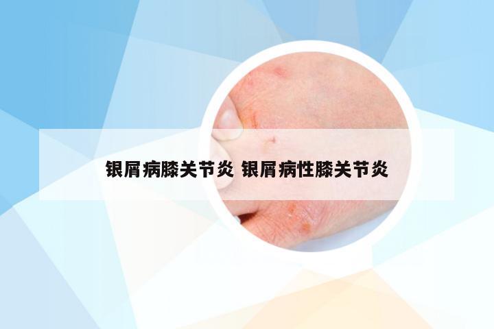 银屑病膝关节炎 银屑病性膝关节炎