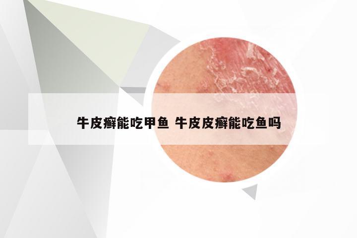 牛皮癣能吃甲鱼 牛皮皮癣能吃鱼吗
