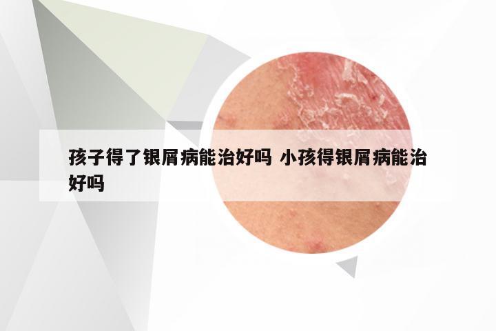 孩子得了银屑病能治好吗 小孩得银屑病能治好吗