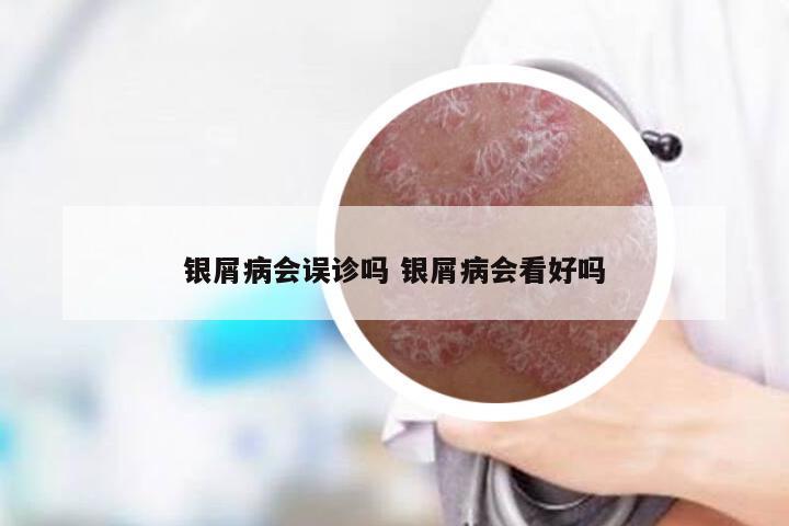 银屑病会误诊吗 银屑病会看好吗