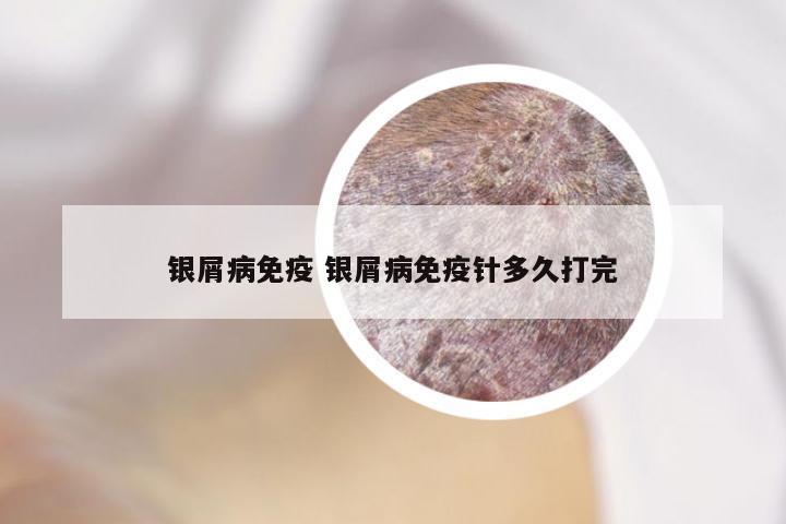 银屑病免疫 银屑病免疫针多久打完