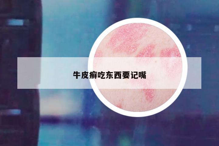牛皮癣吃东西要记嘴