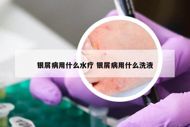 银屑病用什么水疗 银屑病用什么洗液