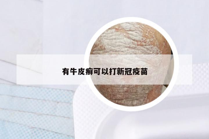 有牛皮癣可以打新冠疫苗