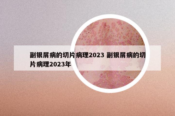副银屑病的切片病理2023 副银屑病的切片病理2023年