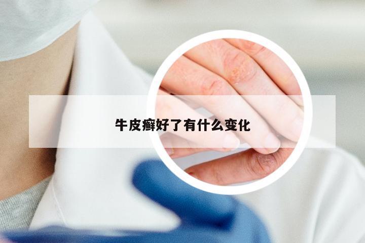 牛皮癣好了有什么变化