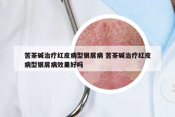 苦茶碱治疗红皮病型银屑病 苦茶碱治疗红皮病型银屑病效果好吗